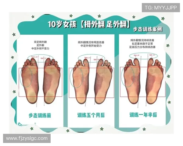 拇外翻困扰足球明星的职业生涯与健康管理探讨 拇外翻困扰足球明星的职业生涯与健康管理探讨